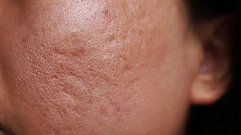 do acne scars ever go away